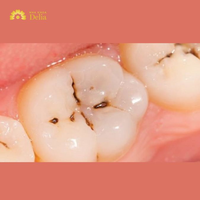Răng nhai bị đen: Nguyên nhân và cách xử lý chi tiết nhất