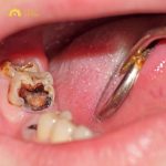 Răng nhai bị sâu: Nguyên nhân, dấu hiệu và cách xử lý hiệu quả