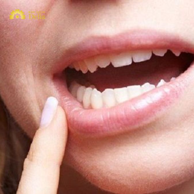Gãy răng cấm có ảnh hưởng gì không? Gãy răng cấm là điềm gì?