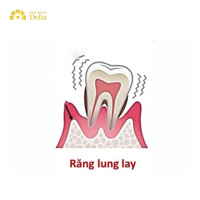 Răng nhai lung lay phải làm sao, có nên nhổ không?