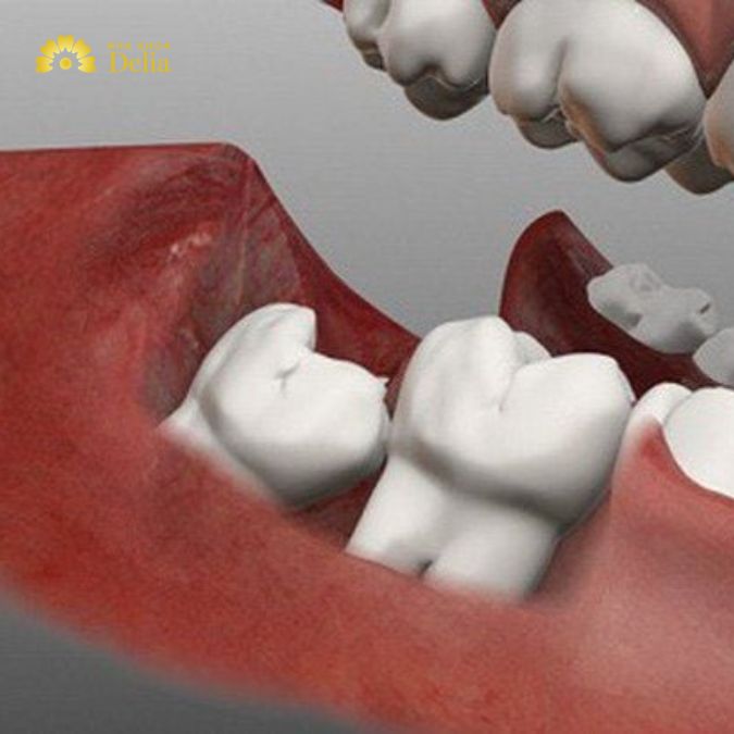 Răng cối có thay không? Răng cối sữa có thay không?