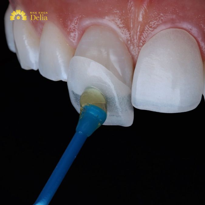 How composite veneers after 5 years hold up: Durability & care