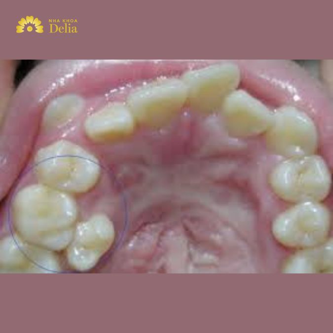 Răng nhai mọc lệch có nguy hiểm không, xử lý như thế nào?