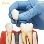 How much does same day dental implant cost, expensive or cheap?
