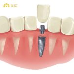 Factors affecting the cost of same day dental implants