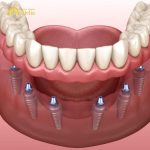 Comprehensive review of All-on-6 dental Implants Thailand