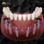 Are All-on-6 dental Implants in Thailand any good?