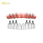 How much do All-on-6 dental Implants cost in Thailand?