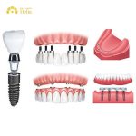 The cost can differ depending on whether you opt for traditional implants, mini implants, or advanced systems like All-on-4 or All-on-6
