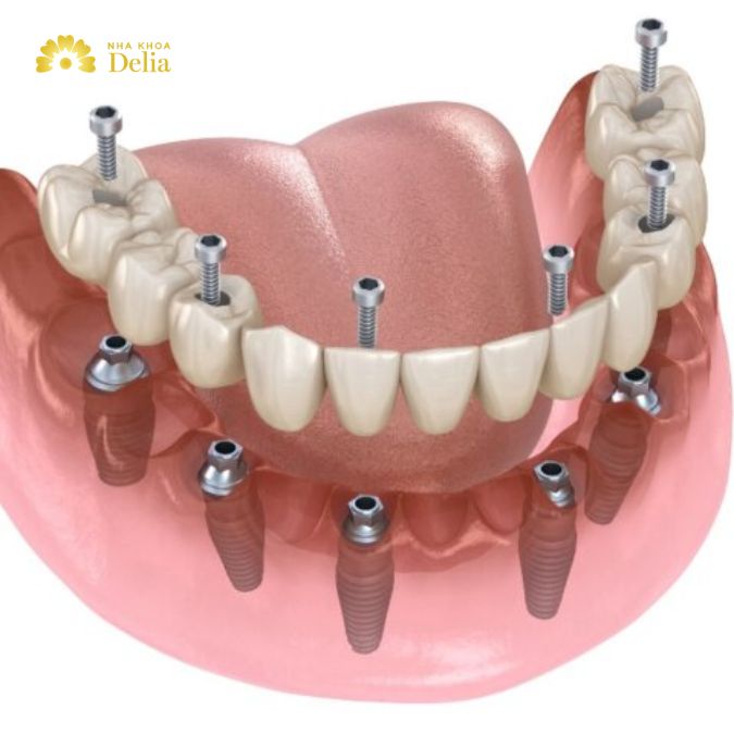 Full mouth dental Implants cost Philippines guide 2025
