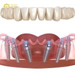 Are dental Implants in Manila, Philippines good?