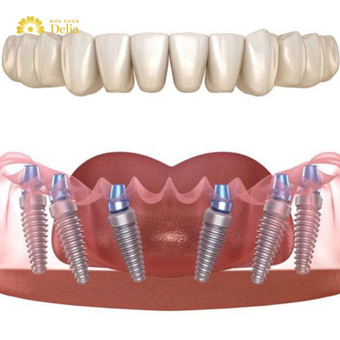 Best dental Implants in Thailand: Expert recommendations