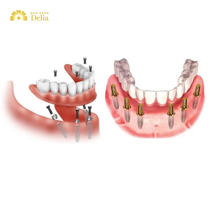 Comprehensive review: Dental Implants Philippines