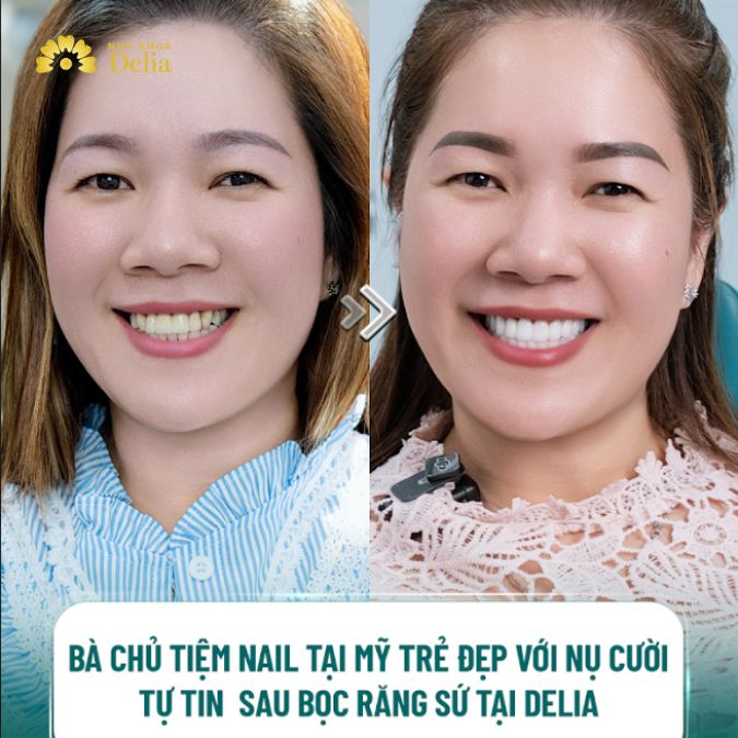 Việt Kiều Mỹ về Việt Nam bọc 20 răng sứ vì nghe theo quảng cáo và cái kết