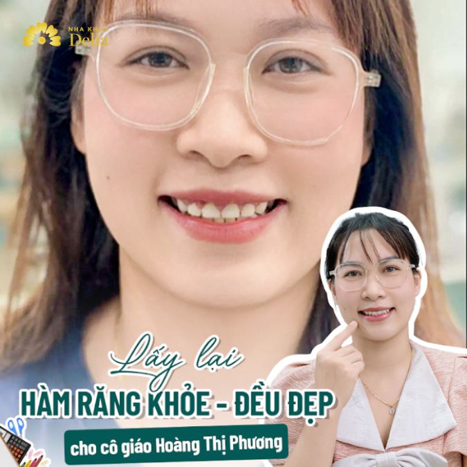 Lấy lại hàm răng khỏe, đều đẹp cho cô giáo trẻ Hoàng Thị Phương