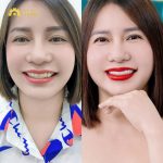 Có lộc hơn, công việc thuận lợi hơn sau khi làm răng sứ tại Delia