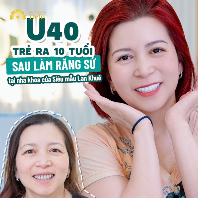 U40 trẻ ra 10 tuổi sau khi làm răng sứ tại nha khoa của siêu mẫu Lan Khuê
