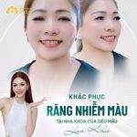 Khắc phục răng nhiễm màu tại nha khoa của siêu mẫu Lan Khuê