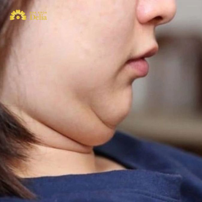 Chia sẻ cách giảm nọng cằm siêu tốc cho chị em tự tin tỏa sáng