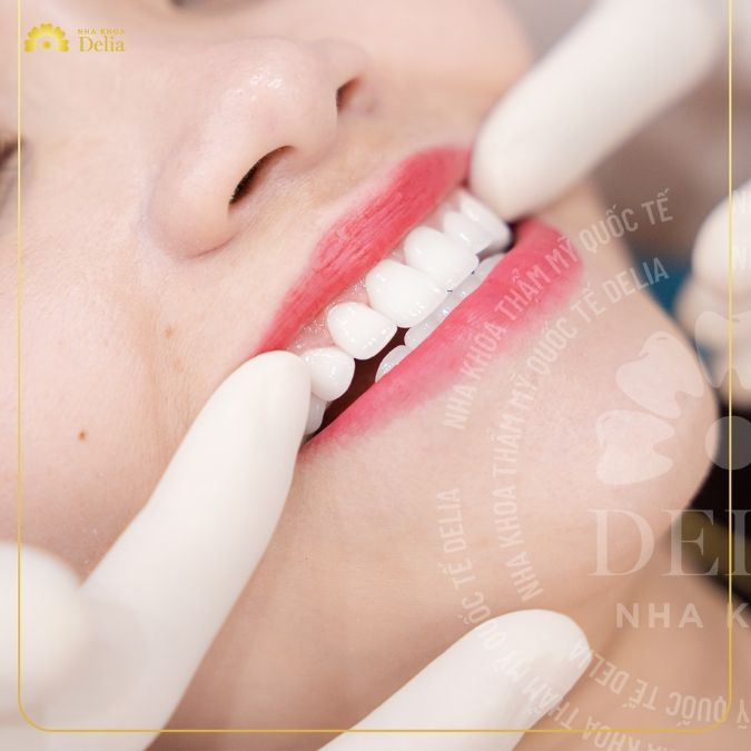 Why choose dental tourism veneers for affordable, high-quality care