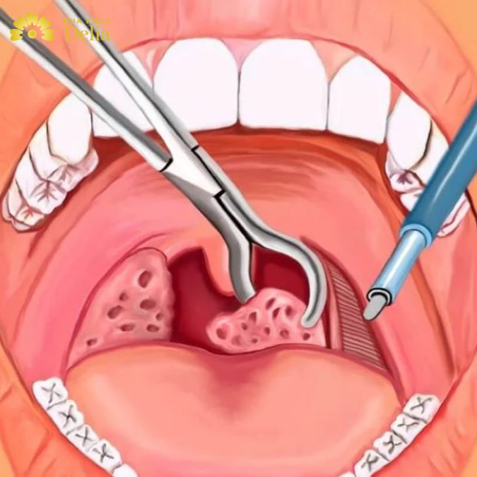 Sau Cắt Amidan Có Được Đánh Răng Không? Những Điều Cần Lưu Ý