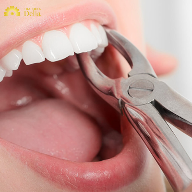 Sau khi nhổ răng bao lâu thì được đánh răng? Hướng dẫn đánh răng đúng cách