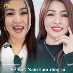 Hình ảnh chị Sophia Ngọc Lê trước và sau khi làm răng sứ tại Delia