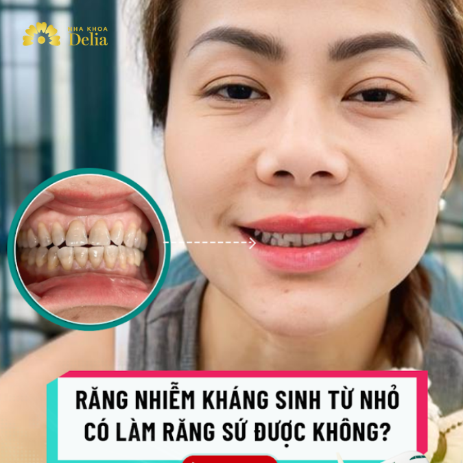 Răng nhiễm Tetracycline từ nhỏ có làm răng sứ được không? – Chị Cianna