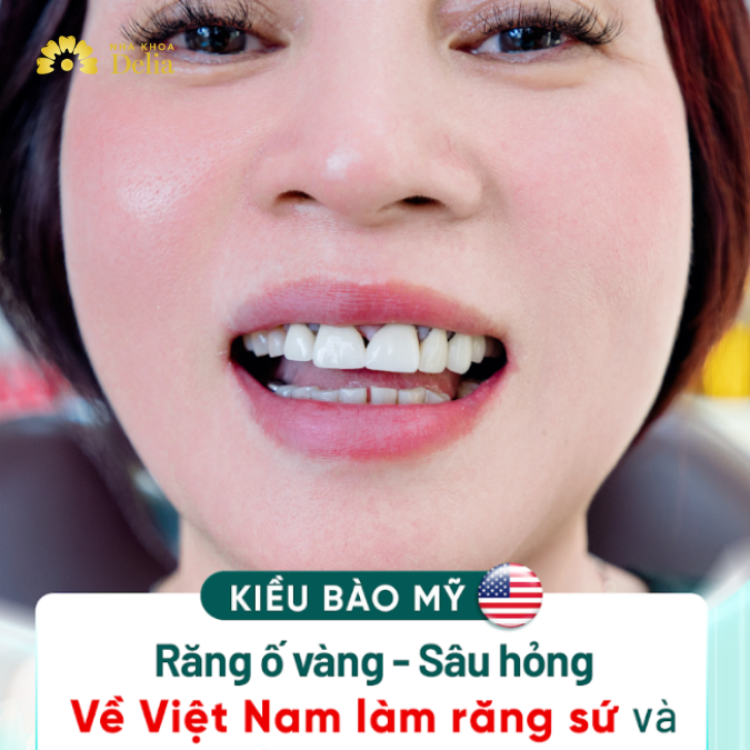 Răng ố vàng, sâu hỏng, về Việt Nam làm răng sứ và cái kết khó tin – Chị Mỹ Linh