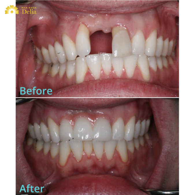 Bridge dental before and after – What you need to know