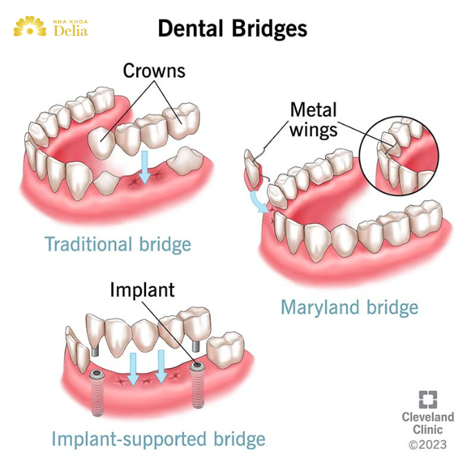 The importance of bridges in dentistry – Restoring function and aesthetics