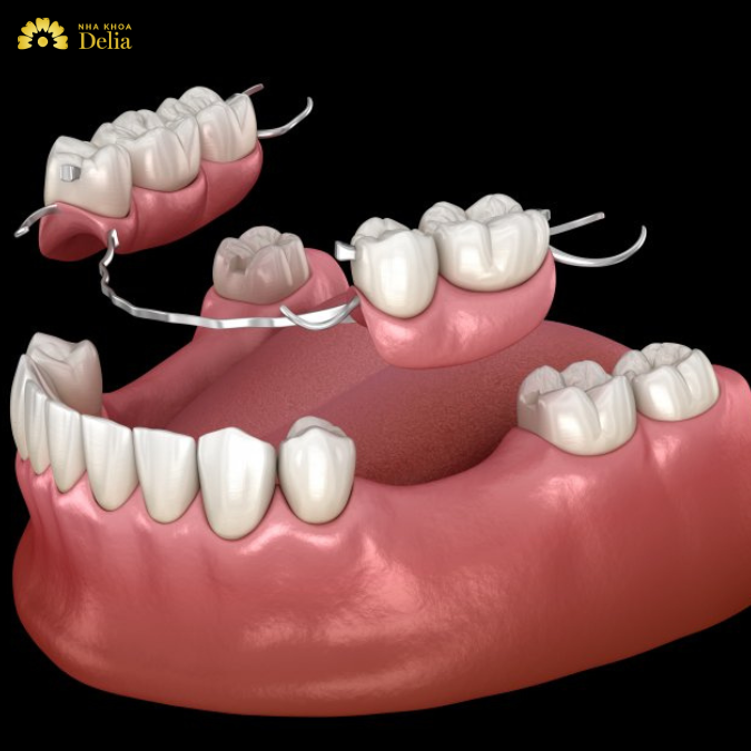 Partial Bridge Dental – An effective solution for missing teeth