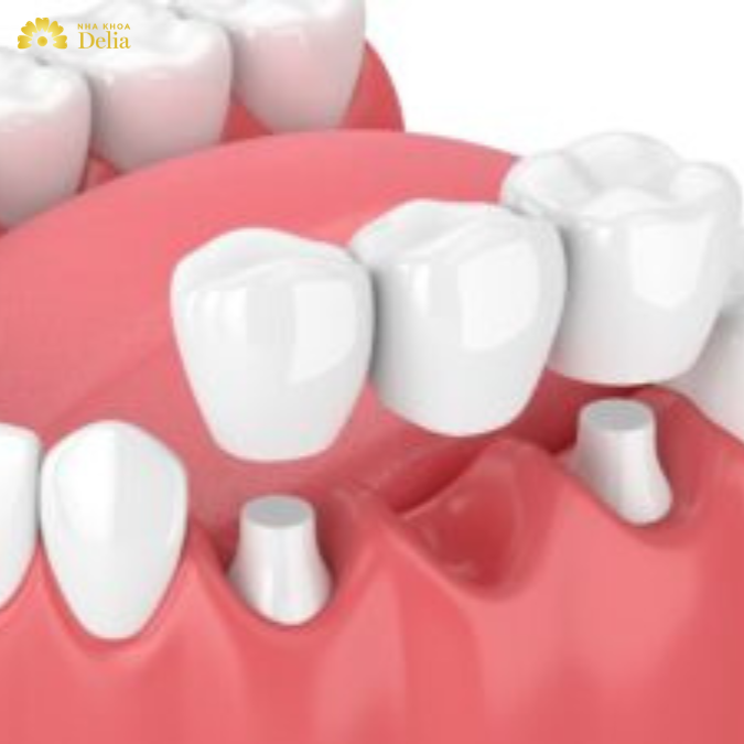 Immediate dentures vs permanent: Which is best for you?