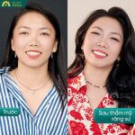 Một hàm răng trắng sáng, đều đẹp tự nhiên, không còn tình trạng hở lợi là những gì mà Huỳnh Như đã nhận được