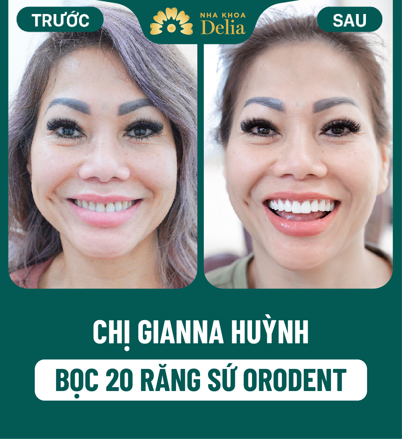 Số răng: Cách đọc và đếm tên của từng loại răng siêu chuẩn