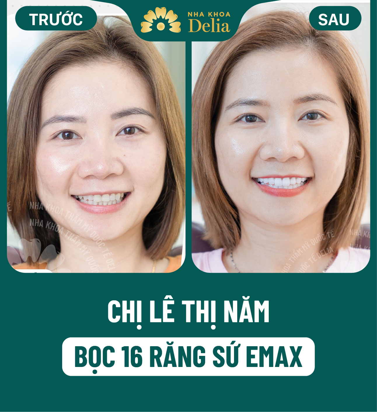 Số răng: Cách đọc và đếm tên của từng loại răng siêu chuẩn