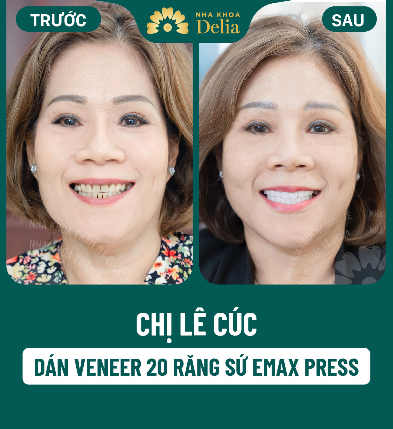 Số răng: Cách đọc và đếm tên của từng loại răng siêu chuẩn