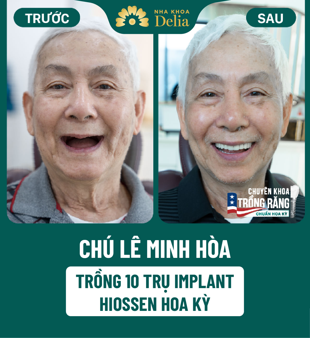 Số răng: Cách đọc và đếm tên của từng loại răng siêu chuẩn