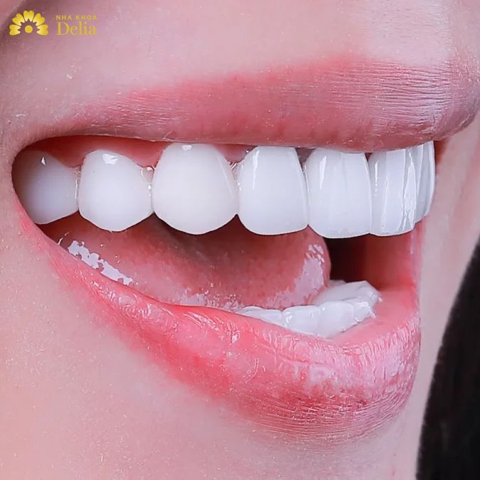 Tẩy trắng răng tại nahf chỉ áp dụng cho những tường hợp ố vàng nhẹ