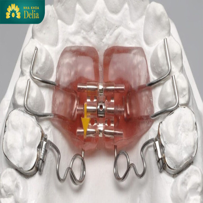 Lợi ích chỉnh nha có ốc nong là hạn chế nhổ răng
