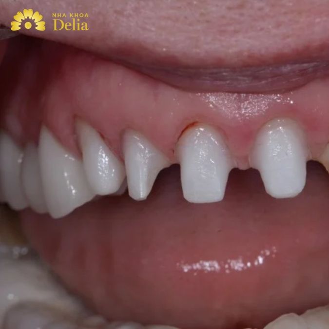 6 dấu hiệu răng sứ có vấn đề, bọc răng sứ bị hỏng