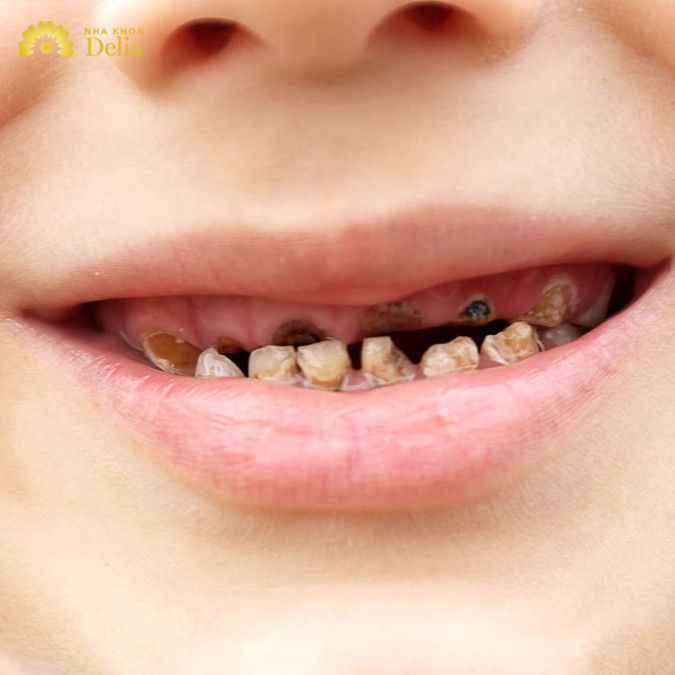 Răng ố vàng ảnh hưởng đến thẩm mỹ, để lâu ảnh hưởng đến sức khỏe, đau răng ăn không ngon