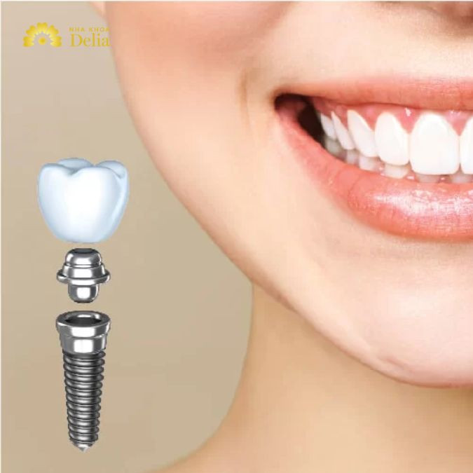 Hướng dẫn chăm sóc răng sau cấy Implant mà bạn nên biết