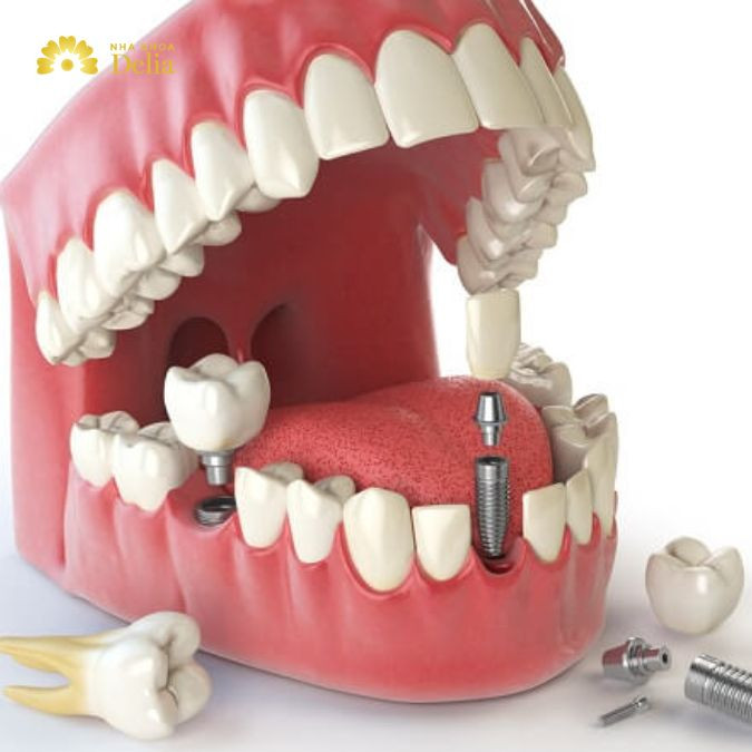 Trồng răng Implant có nhiều ưu điểm nổi bật cho việc phục hình răng
