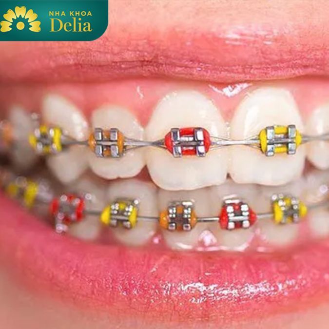 Niềng răng có nguy hiểm không phụ thuộc vào nhiều yếu tố