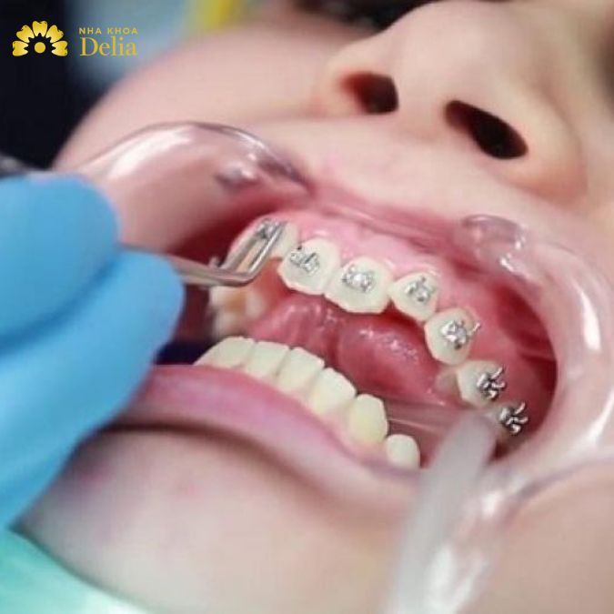 Bạn vẫn có thể gặp một số rủi ro nguy hiểm xuất phát từ 2 yếu tố, đó là: trình độ tay nghề của bác sĩ và ý thức chăm sóc răng miệng