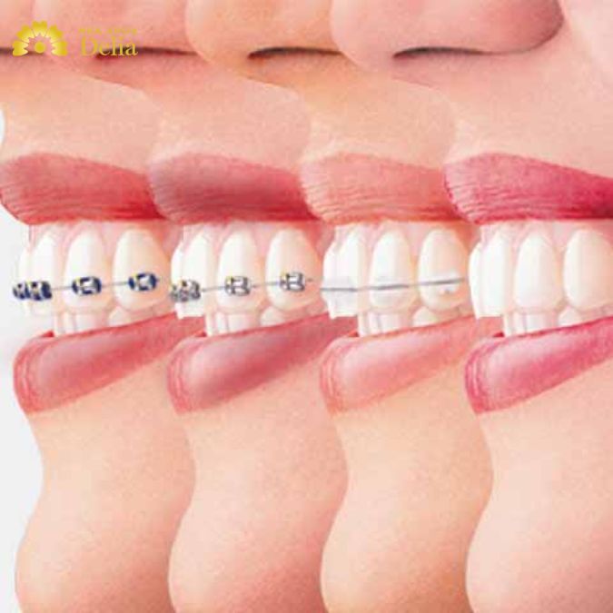 Niềng răng hỗ trợ đưa răng về đúng vị trí và chỉnh sửa khớp cắn đúng tỷ lệ