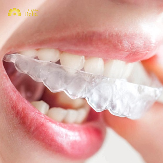 Giá niềng răng Invisalign khá cao, từ 80 - 120 triệu/ ca niềng
