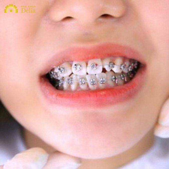 Niềng răng mắc cài kim loại tự buộc (mắc cài kim loại tự động) được cải tiến từ phương pháp niềng răng truyền thống