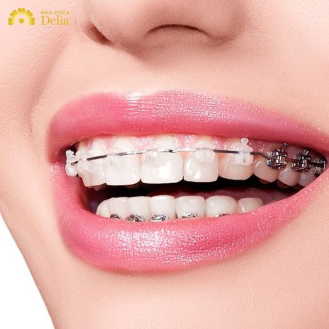 Niềng răng mắc cài tự động là phương pháp niềng răng sử dụng hệ thống mắc cài tự đóng